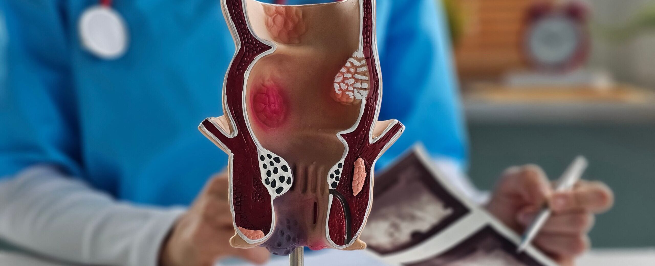 Model anatomiczny odbytu z widocznymi hemoroidami, w tle lekarz w niebieskim kitlu trzymający zdjęcia