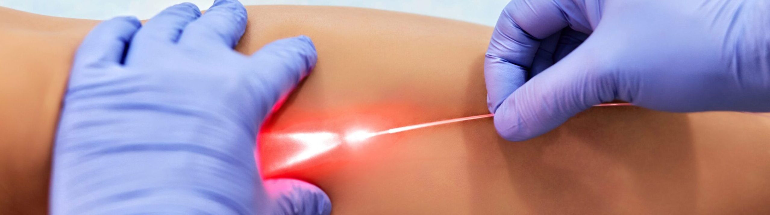 Ręce w fioletowych rękawiczkach trzymające światłowód laserowy nad skórą pacjenta emitujący czerwone światło
